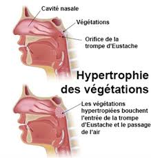 Tout savoir sur l’hypertrophie des végétations adénoïdes : un mal peu connu